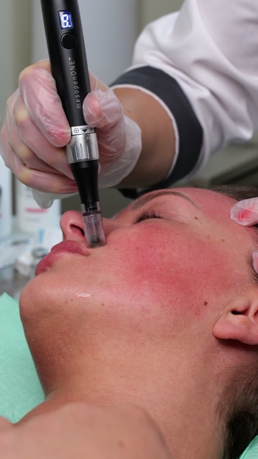 Microneedling med mesopen hos Lumiere Glow Clinic